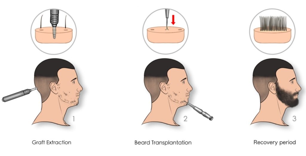 beard-and-moustache-transplant-process-1024×524-1