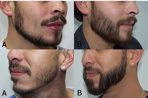 before-and-after-picture-beard-hair-transplant 1