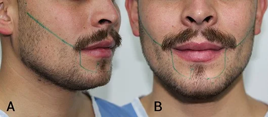 designing-beard-hair-transplant.jpg